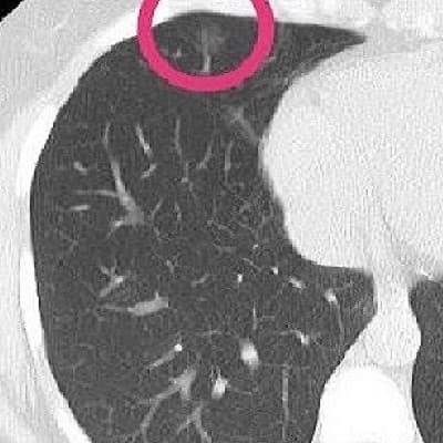I3DR-Net Lung Nodule Detection